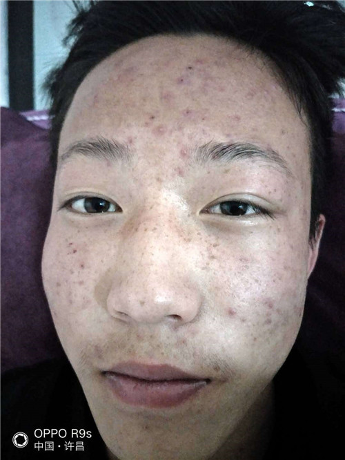 每天那般做，美白祛斑又祛痘