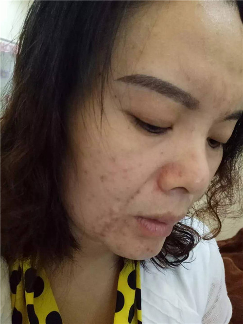 维生素e能不能祛斑祛痘印,看完您就知道了