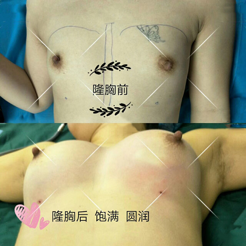 还不知道嵌入硅凝胶鼻子假体的隆胸方法的优势与劣势的看过来：